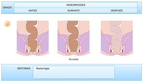 Hemorroides-grado-1