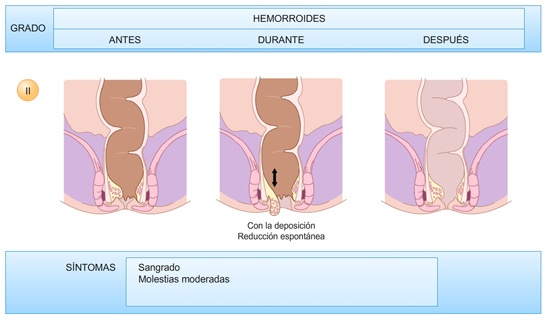 Hemorroides-grado-2