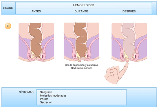 Hemorroides-grado-3